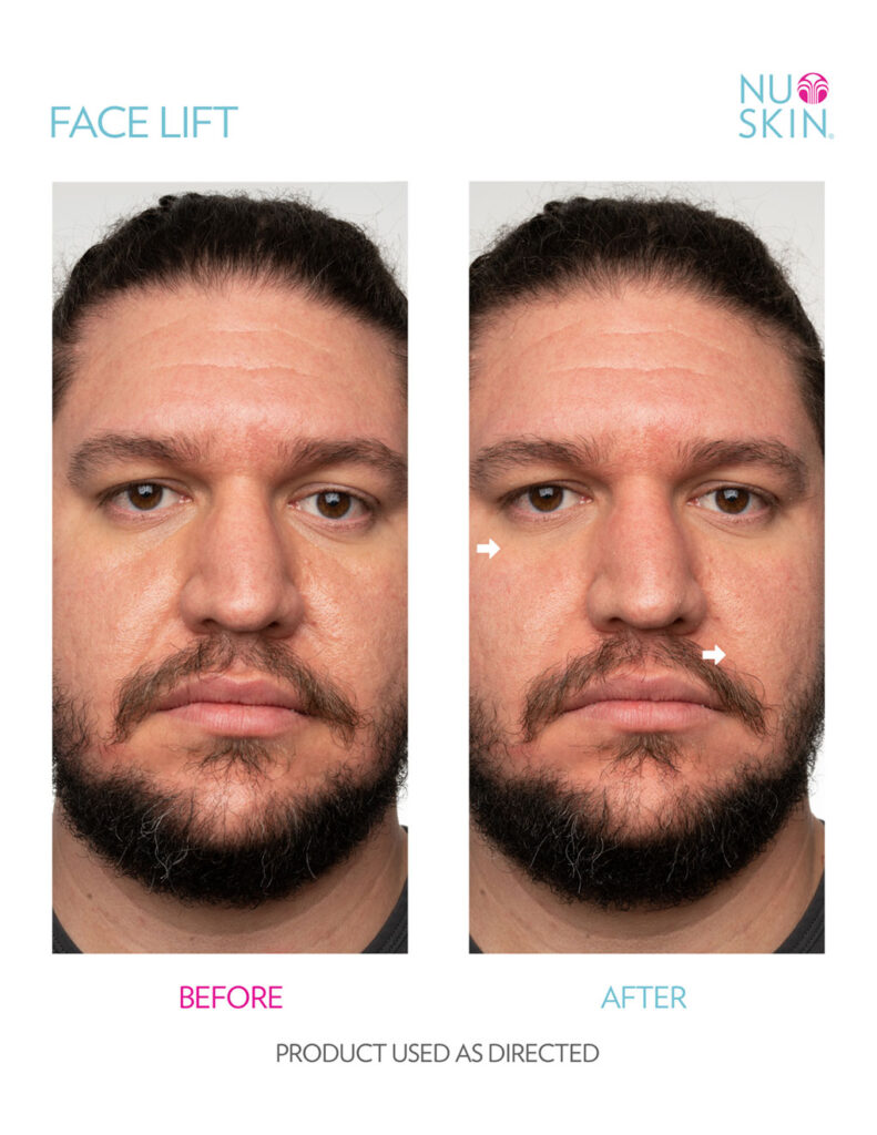 Nu Skin Face Lift Before and After 2