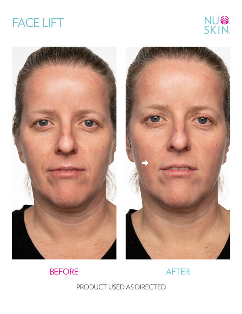 Nu Skin Face Lift Before and After 5
